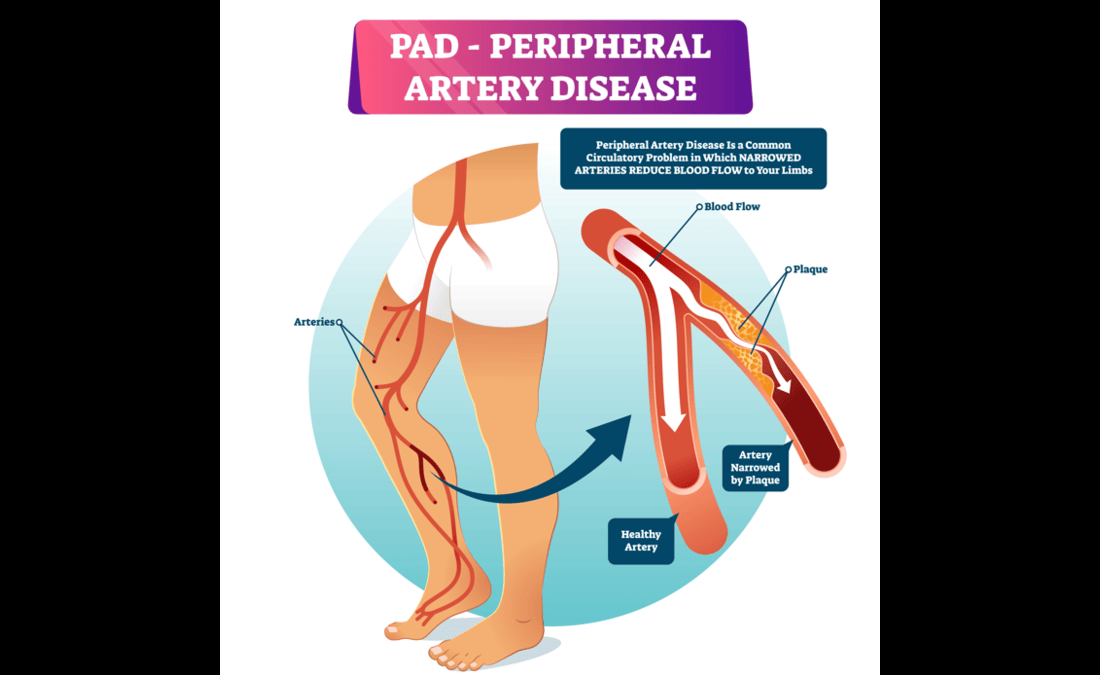 How Long Can I Live With Pavatalgia: Symptoms, Treatment, Life Expectancy, and Long-Term Management Guide
